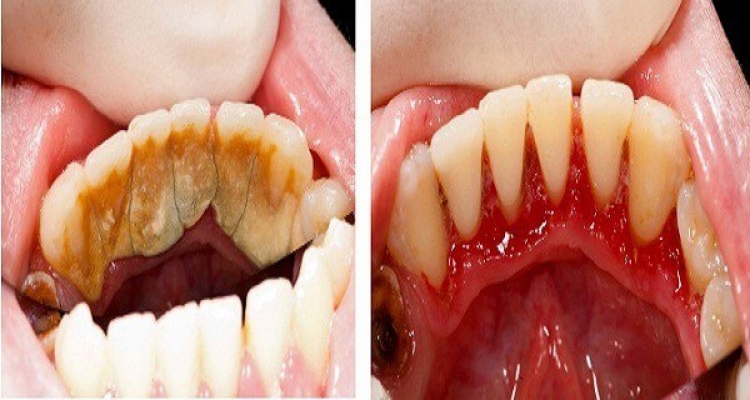 Buďte svým vlastním zubařem! Přinášíme triky, jak lehce odstraníte zubní kámen